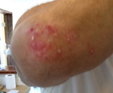 Herb psoriasis elbow before
